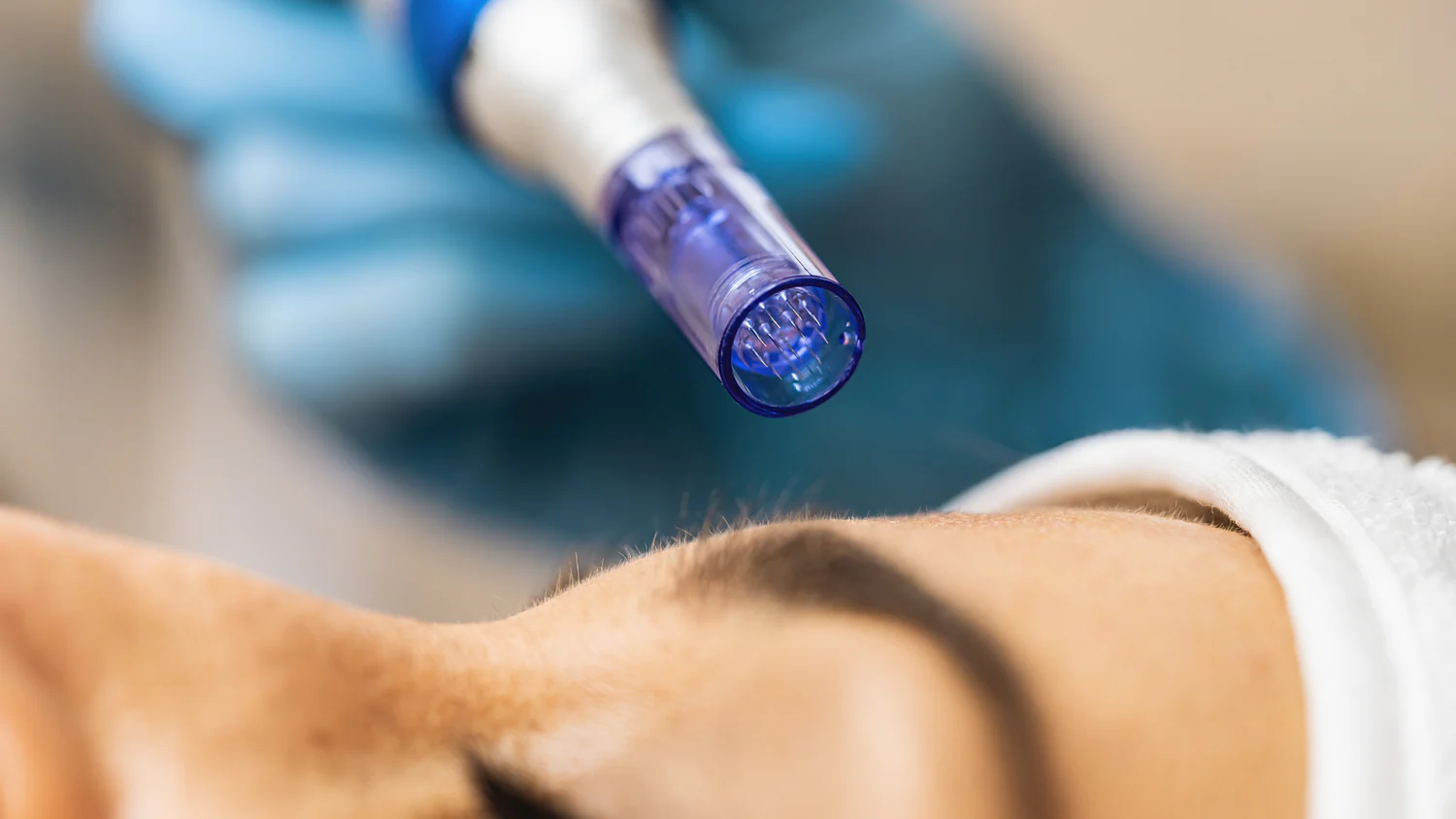 Microneedling (microagujas)